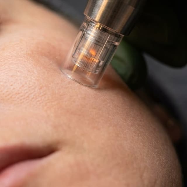 Microdermabrasion Package 3 at Renew & Radiate LLC in Conifer, CO